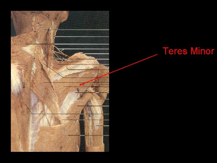 Teres Minor 