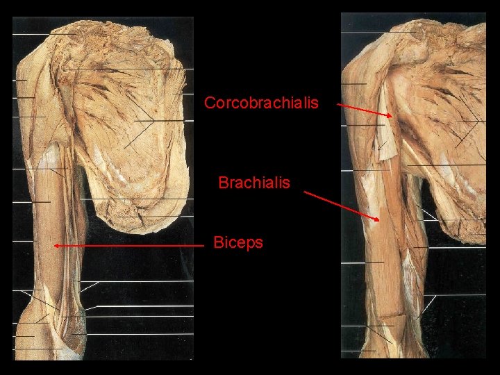 Corcobrachialis Biceps 