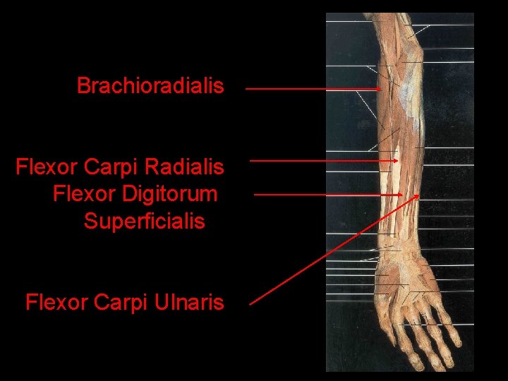 Brachioradialis Flexor Carpi Radialis Flexor Digitorum Superficialis Flexor Carpi Ulnaris 