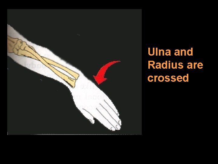 Ulna and Radius are crossed 