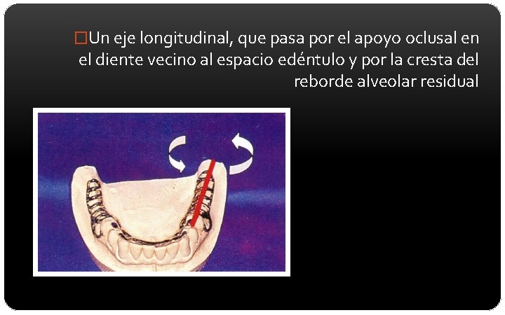 �Un eje longitudinal, que pasa por el apoyo oclusal en el diente vecino al
