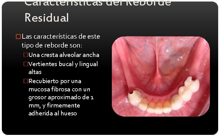 Características del Reborde Residual � Las características de este tipo de reborde son: �Una