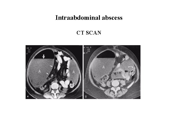 Intraabdominal abscess CT SCAN 
