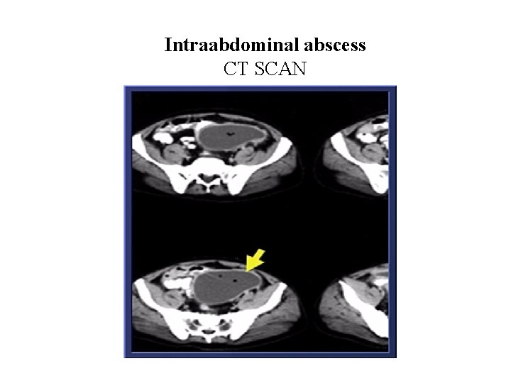 Intraabdominal abscess CT SCAN 