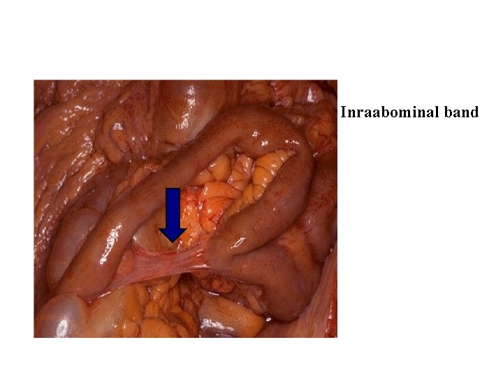Inraabominal band 
