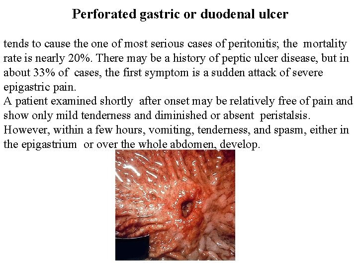 Perforated gastric or duodenal ulcer tends to cause the one of most serious cases