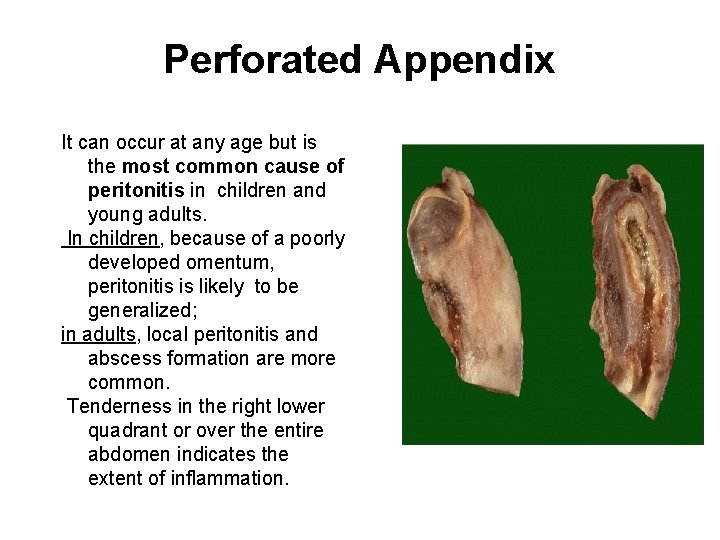 Perforated Appendix It can occur at any age but is the most common cause
