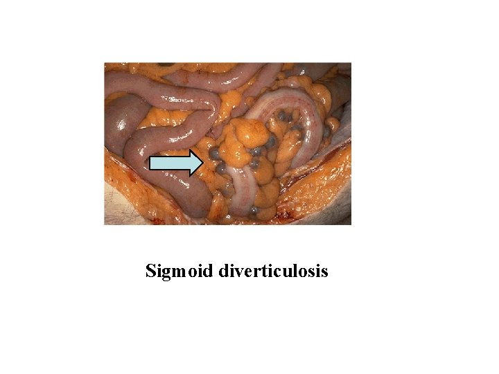 Sigmoid diverticulosis 