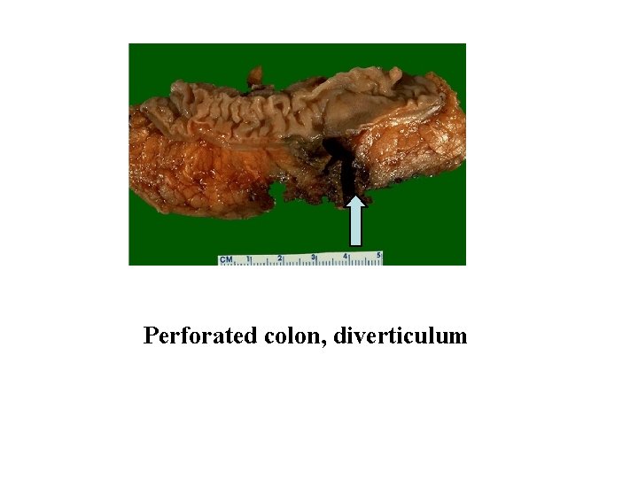 Perforated colon, diverticulum 