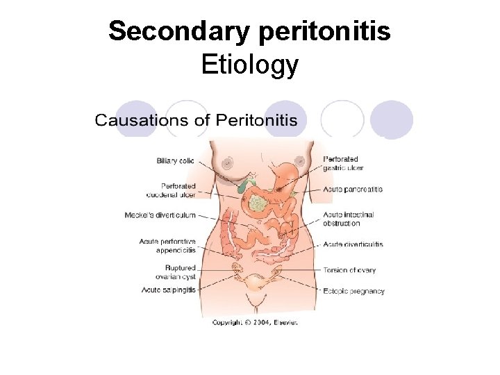 Secondary peritonitis Etiology 