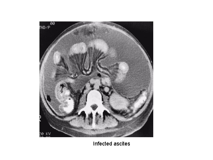 Infected ascites 