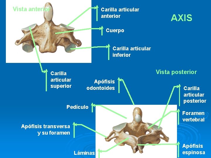 Vista anterior Carilla articular anterior AXIS Cuerpo Carilla articular inferior Carilla articular superior Vista