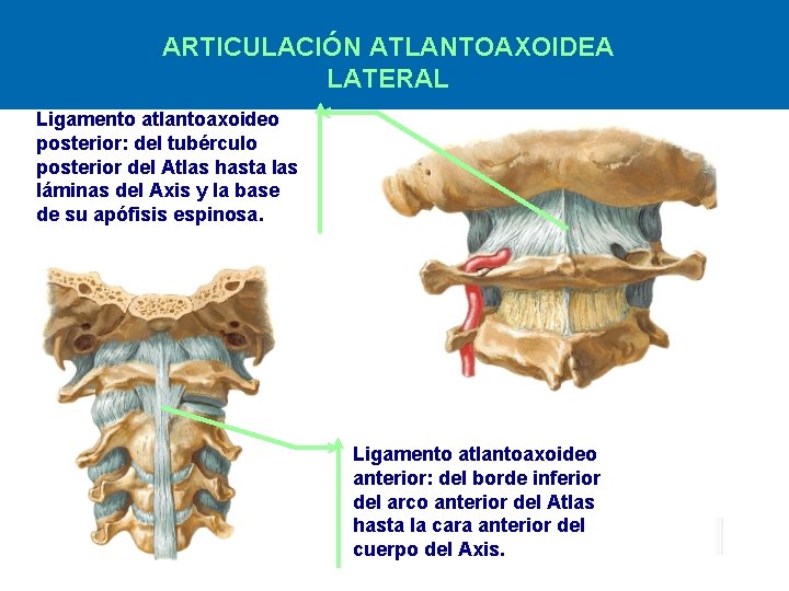 ARTICULACIÓN ATLANTOAXOIDEA LATERAL Ligamento atlantoaxoideo posterior: del tubérculo posterior del Atlas hasta las láminas ARTICULACIÓN ATLANTOAXOIDEA LATERAL Ligamento atlantoaxoideo posterior: del tubérculo posterior del Atlas hasta las láminas