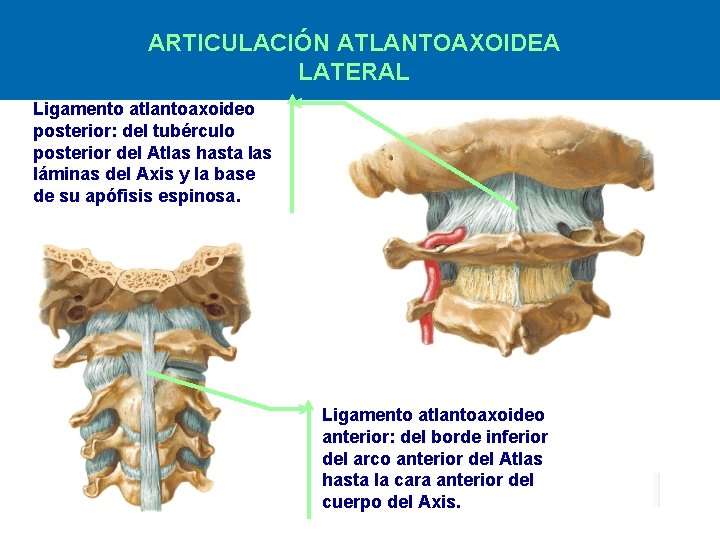 ARTICULACIÓN ATLANTOAXOIDEA LATERAL Ligamento atlantoaxoideo posterior: del tubérculo posterior del Atlas hasta las láminas