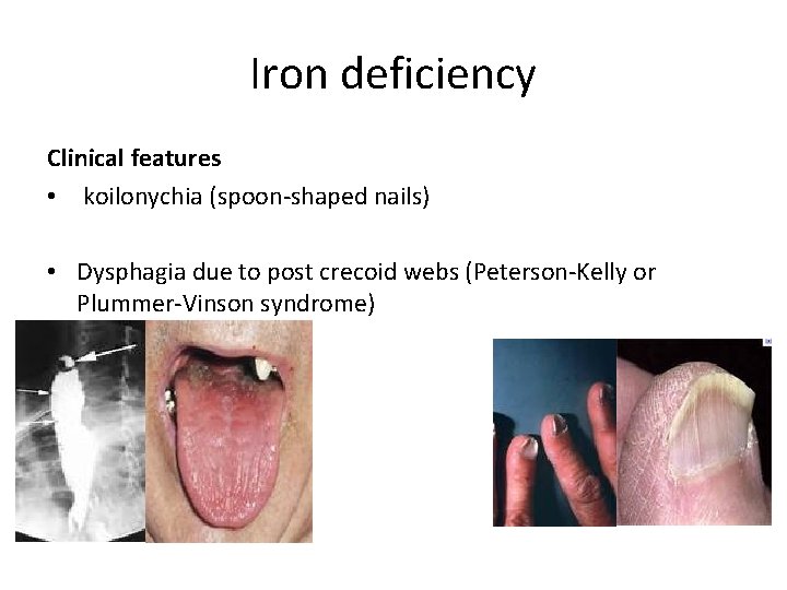 Iron deficiency Clinical features • koilonychia (spoon-shaped nails) • Dysphagia due to post crecoid