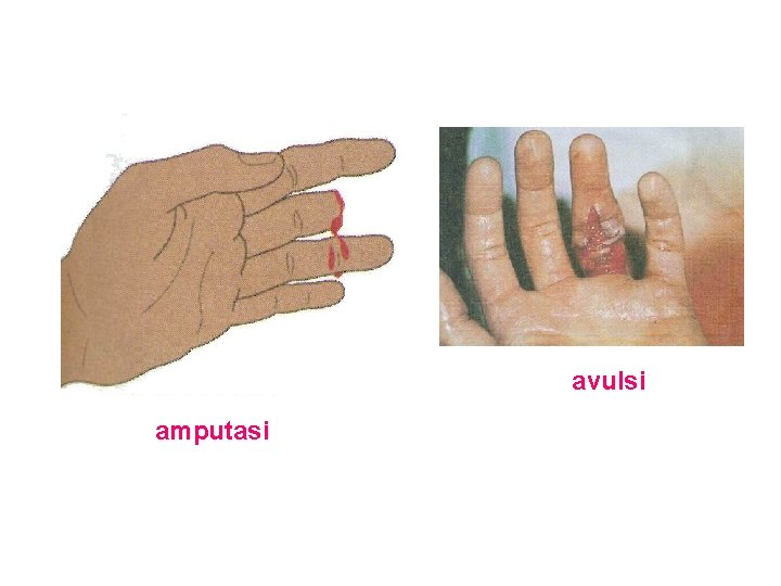 avulsi amputasi avulsi amputasi