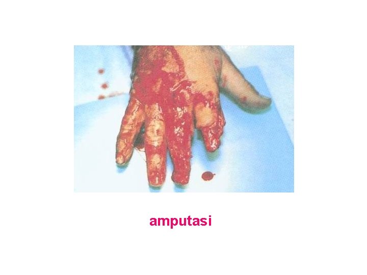 amputasi amputasi