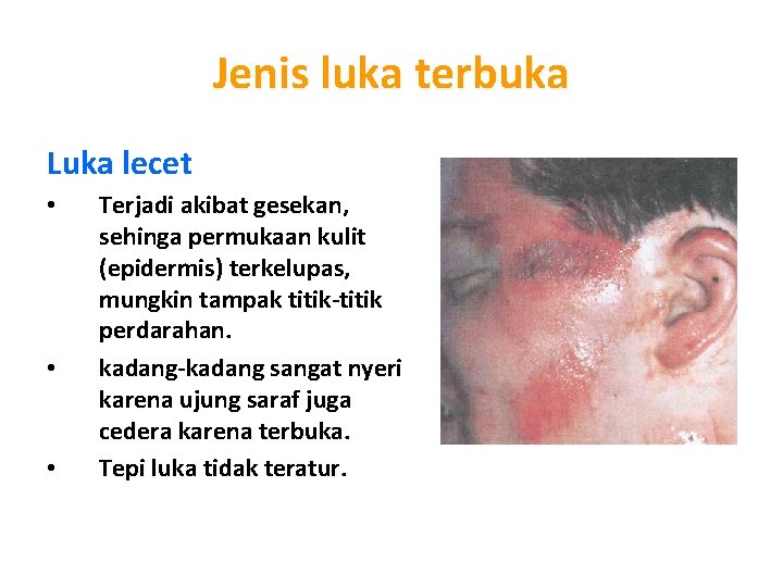 Jenis luka terbuka Luka lecet • • • Terjadi akibat gesekan, sehinga permukaan kulit Jenis luka terbuka Luka lecet • • • Terjadi akibat gesekan, sehinga permukaan kulit