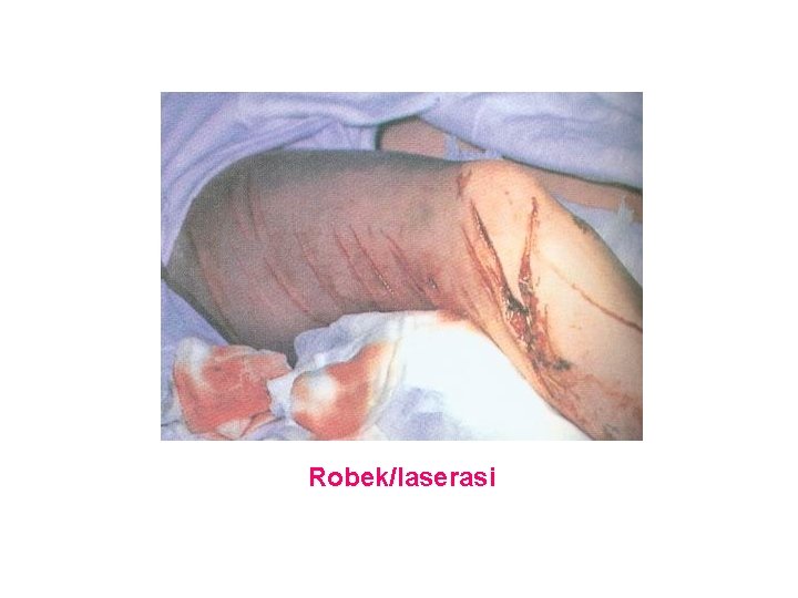 Robek/laserasi Robek/laserasi