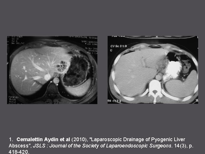 1. Cemalettin Aydin et al (2010), "Laparoscopic Drainage of Pyogenic Liver Abscess", JSLS :