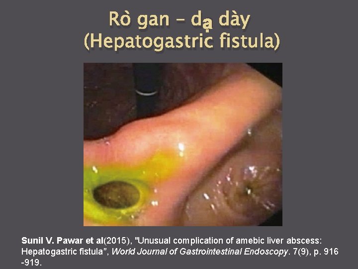 Rò gan – dạ dày (Hepatogastric fistula) Sunil V. Pawar et al(2015), "Unusual complication