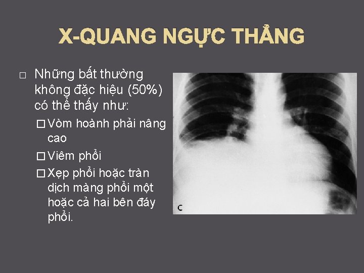 X-QUANG NGỰC THẲNG � Những bất thường không đặc hiệu (50%) có thể thấy