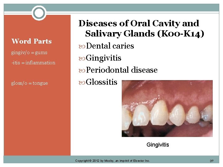 Word Parts gingiv/o = gums -itis = inflammation gloss/o = tongue Diseases of Oral