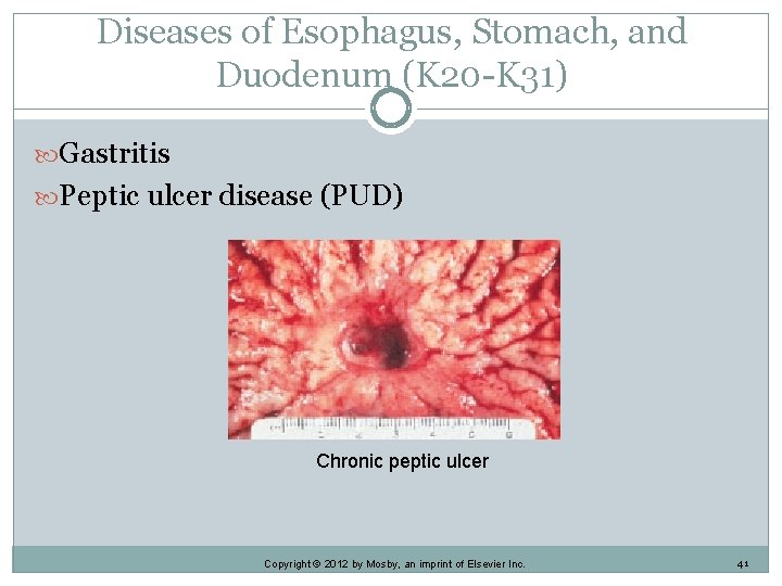 Diseases of Esophagus, Stomach, and Duodenum (K 20 -K 31) Gastritis Peptic ulcer disease