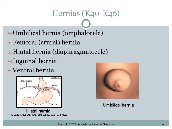 Hernias (K 40 -K 46) Umbilical hernia (omphalocele) Femoral (crural) hernia Hiatal hernia (diaphragmatocele)