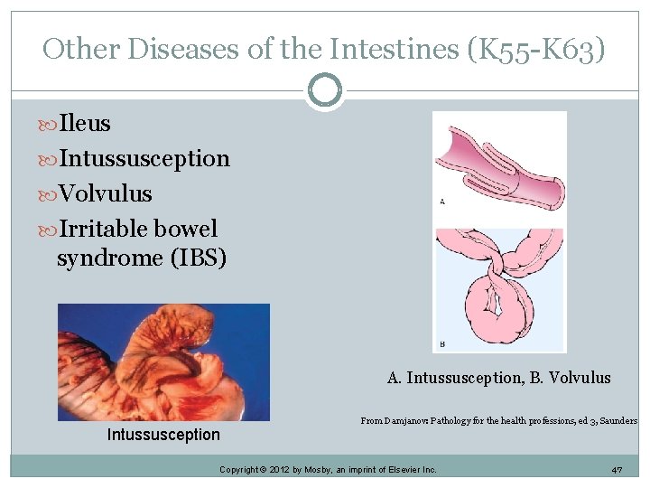 Other Diseases of the Intestines (K 55 -K 63) Ileus Intussusception Volvulus Irritable bowel