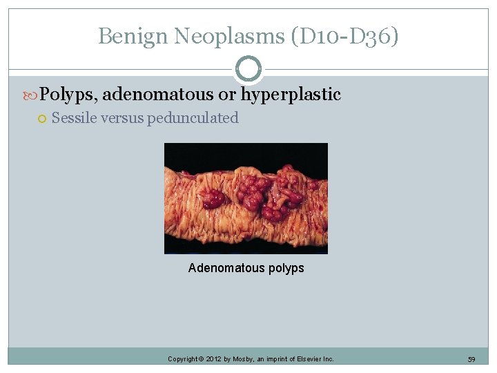 Benign Neoplasms (D 10 -D 36) Polyps, adenomatous or hyperplastic Sessile versus pedunculated Adenomatous
