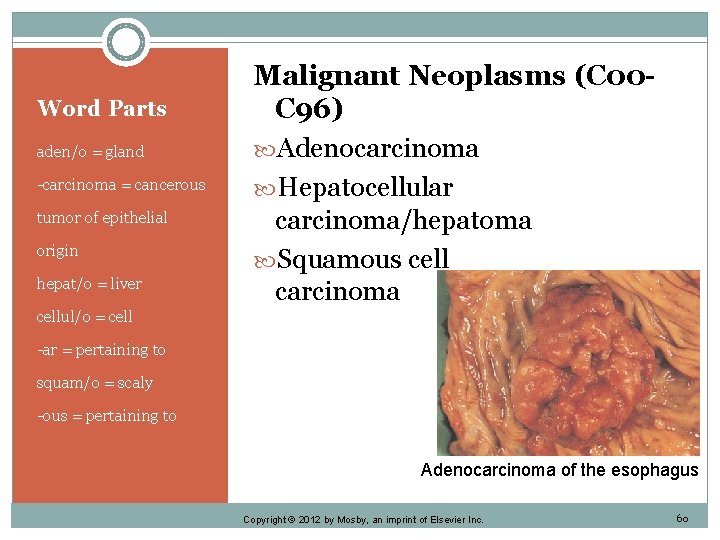 Word Parts aden/o = gland -carcinoma = cancerous tumor of epithelial origin hepat/o =