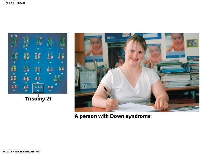 Figure 8. 20 a-0 Trisomy 21 A person with Down syndrome © 2015 Pearson