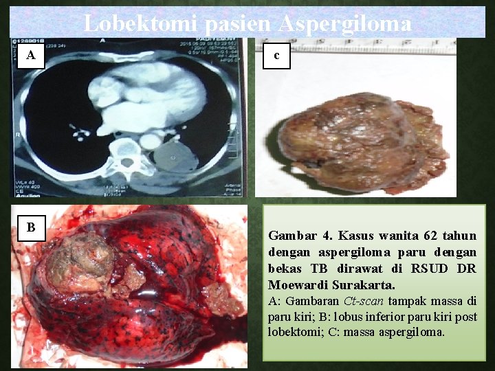 Lobektomi pasien Aspergiloma A B c Gambar 4. Kasus wanita 62 tahun dengan aspergiloma