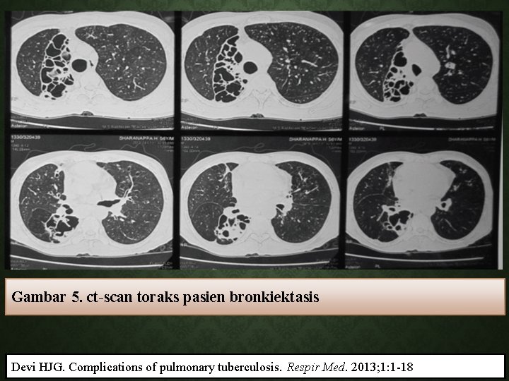 Gambar 5. ct-scan toraks pasien bronkiektasis Devi HJG. Complications of pulmonary tuberculosis. Respir Med.