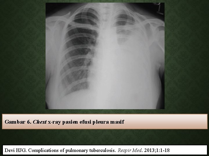 Gambar 6. Chest x-ray pasien efusi pleura masif Devi HJG. Complications of pulmonary tuberculosis.