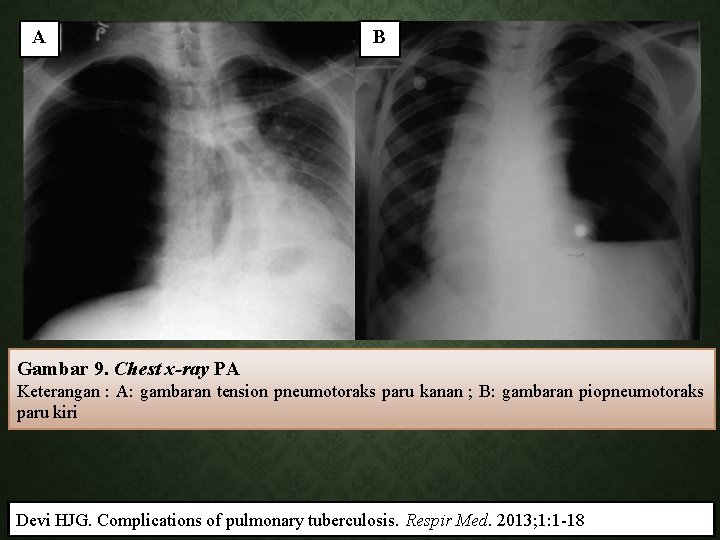 A B Gambar 9. Chest x-ray PA Keterangan : A: gambaran tension pneumotoraks paru