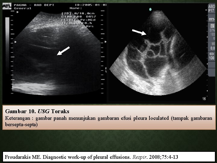 Gambar 10. USG Toraks Keterangan : gambar panah menunjukan gambaran efusi pleura loculated (tampak