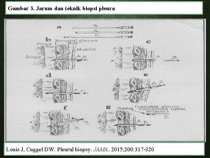 Gambar 3. Jarum dan teknik biopsi pleura Louis J, Cuggel DW. Pleural biopsy. JAMA.