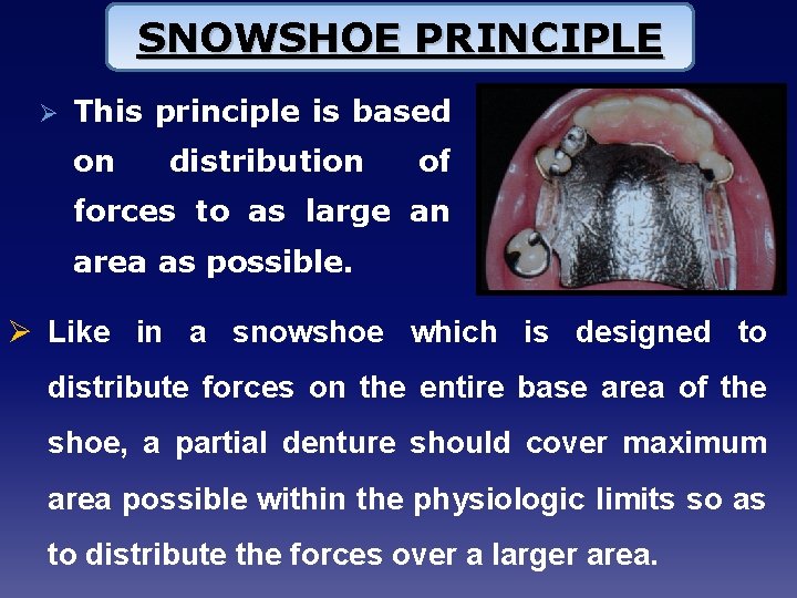 SNOWSHOE PRINCIPLE Ø This principle is based on distribution of forces to as large