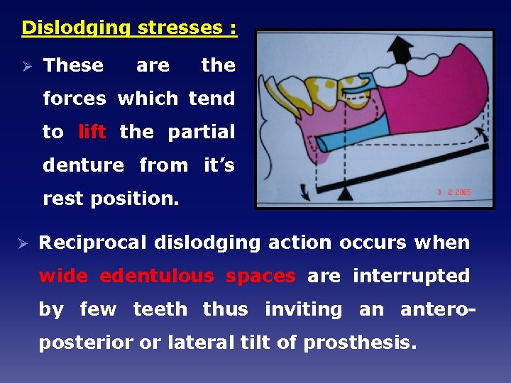 Dislodging stresses : Ø These are the forces which tend to lift the partial