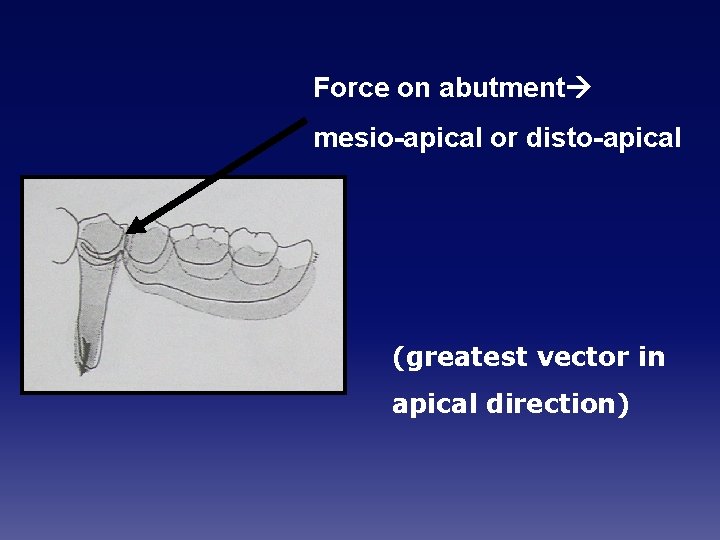 Force on abutment mesio-apical or disto-apical (greatest vector in apical direction) 