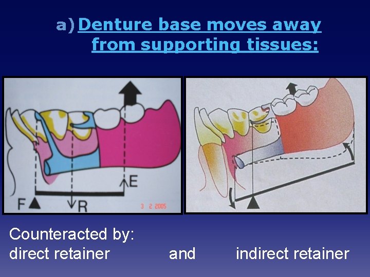 a) Denture base moves away from supporting tissues: Counteracted by: direct retainer and indirect