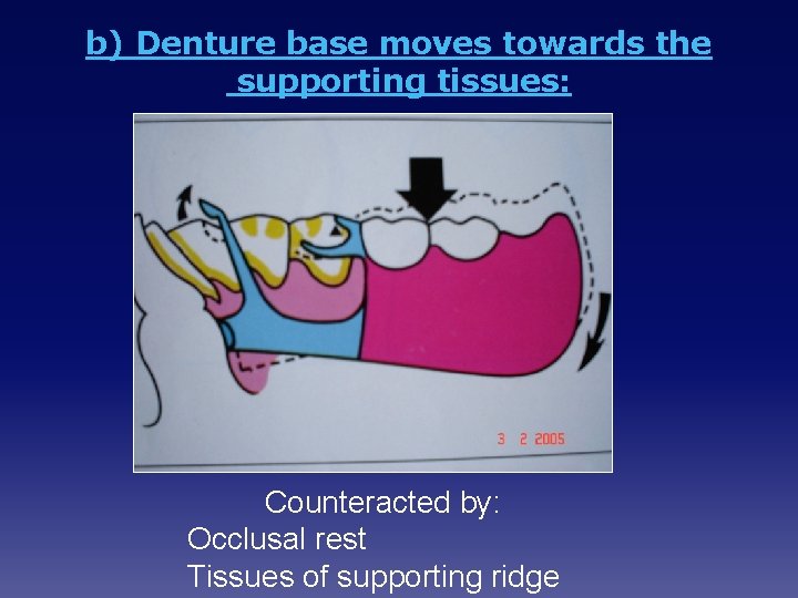 b) Denture base moves towards the supporting tissues: Counteracted by: Occlusal rest Tissues of