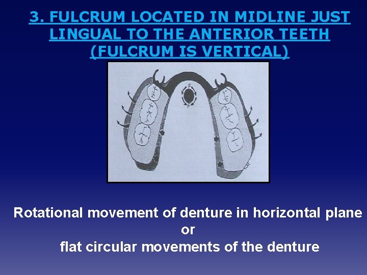 3. FULCRUM LOCATED IN MIDLINE JUST LINGUAL TO THE ANTERIOR TEETH (FULCRUM IS VERTICAL)