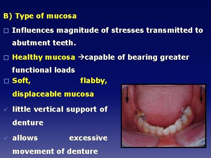 B) Type of mucosa � Influences magnitude of stresses transmitted to abutment teeth. �