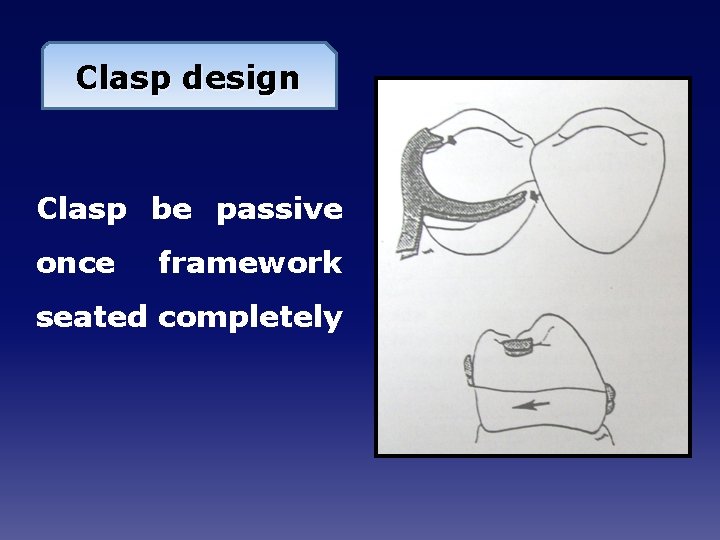 Clasp design Clasp be passive once framework seated completely 