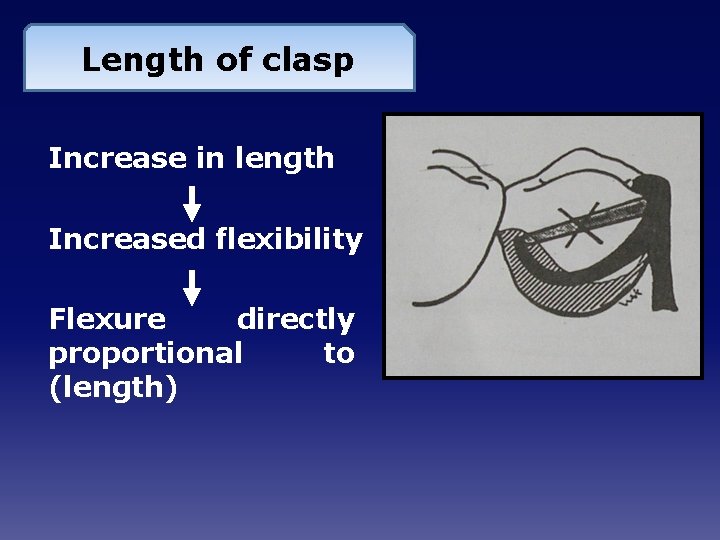 Length of clasp Increase in length Increased flexibility Flexure directly proportional to (length) 