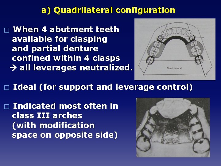 a) Quadrilateral configuration When 4 abutment teeth available for clasping and partial denture confined