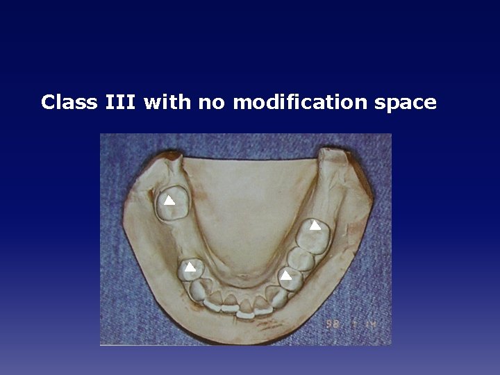Class III with no modification space 